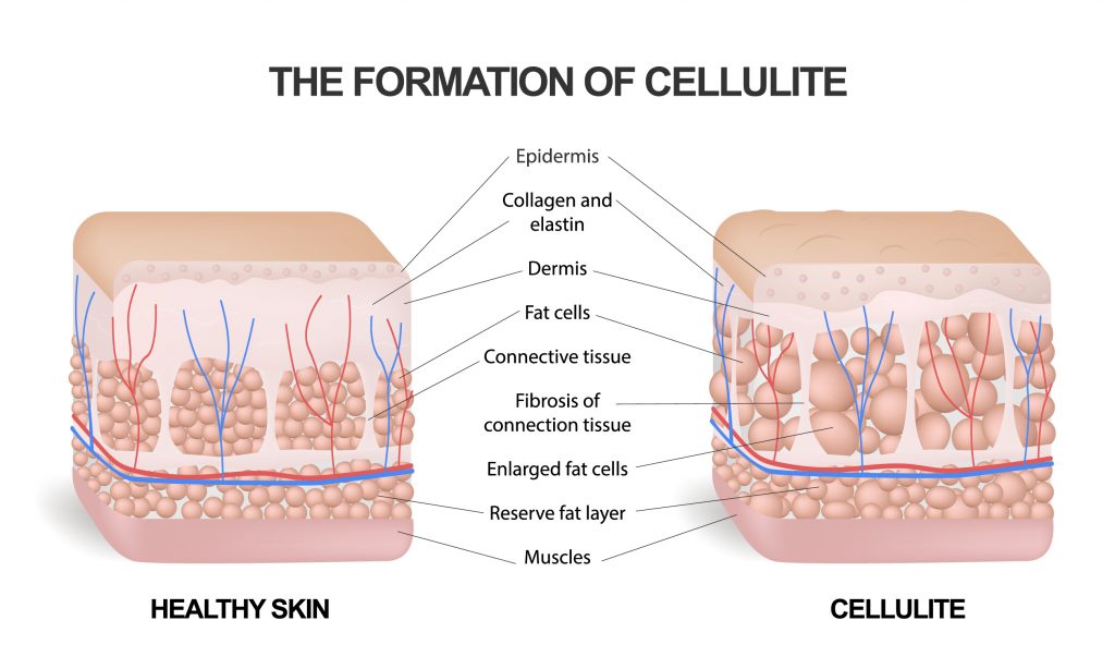Formation of the cellulite